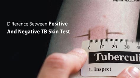what does a positive tb test look like|Testing for Tuberculosis .